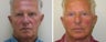 Facelift Before & After Photos