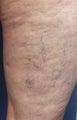Sclerotherapy
