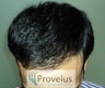 N/W 4A, Indian, 3400 graft FUE