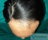 N/W 4A, Indian, 3400 graft FUE