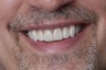 Smile Makeover
