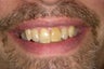 Smile Makeover