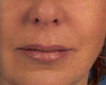 Facial Filler