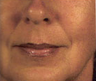 Facial Filler