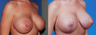 Revision Breast Surgery