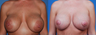 Revision Breast Surgery