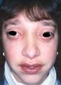 Female patient who underwent nose surgery 