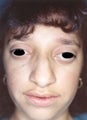 Female patient who underwent nose surgery 