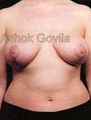 Breast Lift