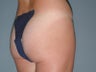 Brazilian Butt Lift