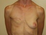 Breast Reconstruction