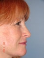 Rhinoplasty