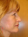 Rhinoplasty