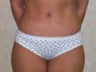 Tummy Tuck