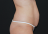 Abdominoplasty