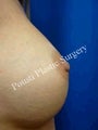Nipple-areola Repair
