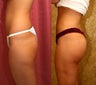 Butt Augmentation or Brazilian Butt Lift