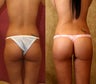 Butt Augmentation or Brazilian Butt Lift