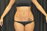 Liposuction