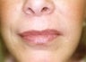 Female patient who underwent laser surgery 