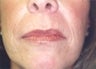Female patient who underwent laser surgery 