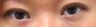 Bilateral Asian Eyelid Surgery