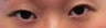 Bilateral Asian Eyelid Surgery