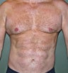 42 Year Old Male Who Desired Six-Pack Abs