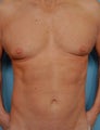 42 Year Old Male Who Desired Six-Pack Abs