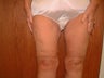 64 year old woman had Thigh Lift surgery