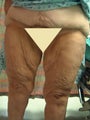 64 year old woman had Thigh Lift surgery