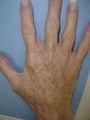 Hand Veins