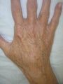 Hand Veins