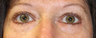 Eyelid Surgery