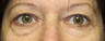 Eyelid Surgery