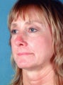 Full face laser skin resurfacing