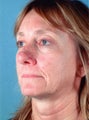 Full face laser skin resurfacing
