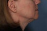 Female treated for Sagging Skin at Jawline