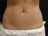 CoolSculpting