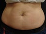 CoolSculpting