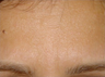 48 year old treated for frown lines