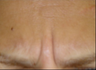 48 year old treated for frown lines