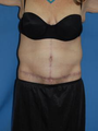 Circumferential Tuck