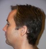 41 year old man gets Chin Implant Surgery
