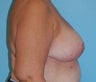 Breast Reduction