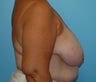 Breast Reduction