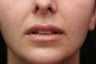 26 year old young lady who requested more even, fuller and natural looking lips