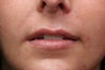 26 year old young lady who requested more even, fuller and natural looking lips