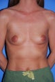 Breast Implants