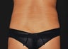 Liposuction